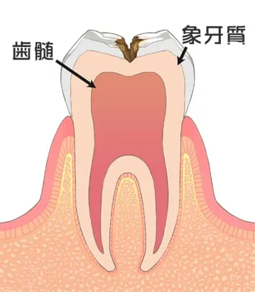 虫歯 C2