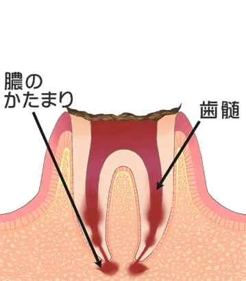 虫歯 C4