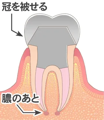 2次カリエス