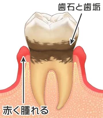 歯周病の進行1