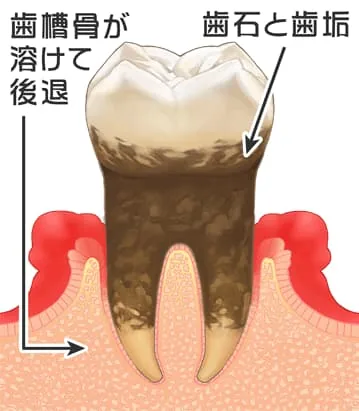 歯周病の進行2