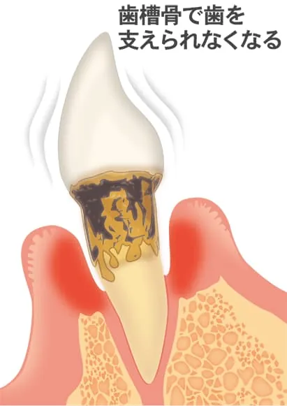 歯周病の進行3　側面