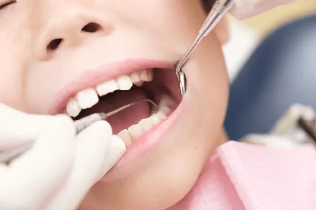 歯垢・歯石の除去イメージ
