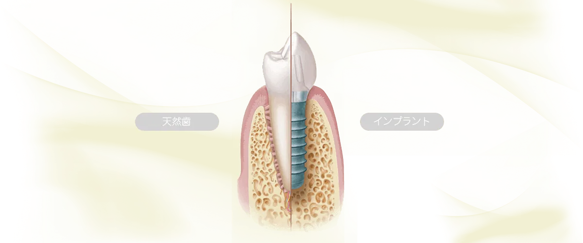 インプラントと健康な歯のイメージ