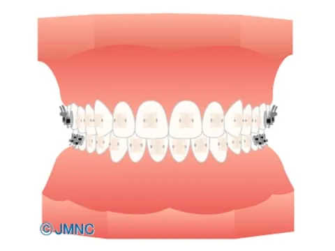 審美ブラケット (表側矯正) イラスト
