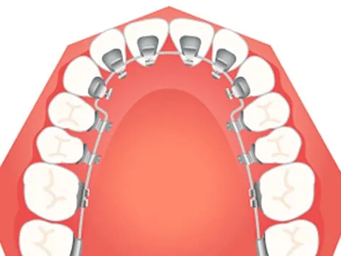 リンガルブラケット (裏側矯正) イラスト