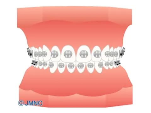 金属ブラケット (表側矯正) イラスト